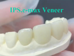 EMAX Veneer راه حل ایده ای برای بازسازی دندان های پایدار و زیبایی شناختی