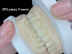 IPS.emax Veneer راه حل زیبایی برای تغییر لبخند خارق العاده