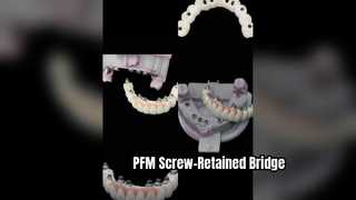 ترمیم ایمپلنت PFM Screw Retained Precision
