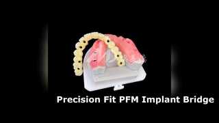 فیت دقیق پل ایمپلنت PFM با استحکام بالا