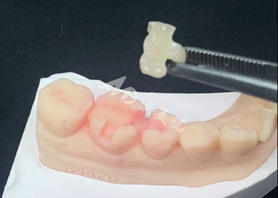 خرید اماکس سرامیک اینلایز آنلایز بازسازی دندان برای رنگ طبیعی دندان و نگهداری آسان online manufacture