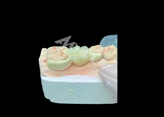 خرید تاج زرکونیا با پل بسته شده HPP برای افزایش زیبایی لبخند و سازگاری زیستی online manufacture