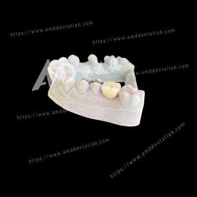 خرید بریج مریلند PFM مریلند یک پونتیک دو بال یک راه حل محافظه کارانه و زیبایی online manufacture