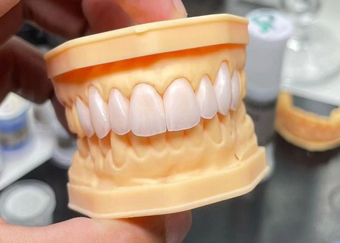 پل تاج سرامیکی با قدرت بالا با سازگاری بیولوژیکی استثنایی برای دوام طولانی مدت