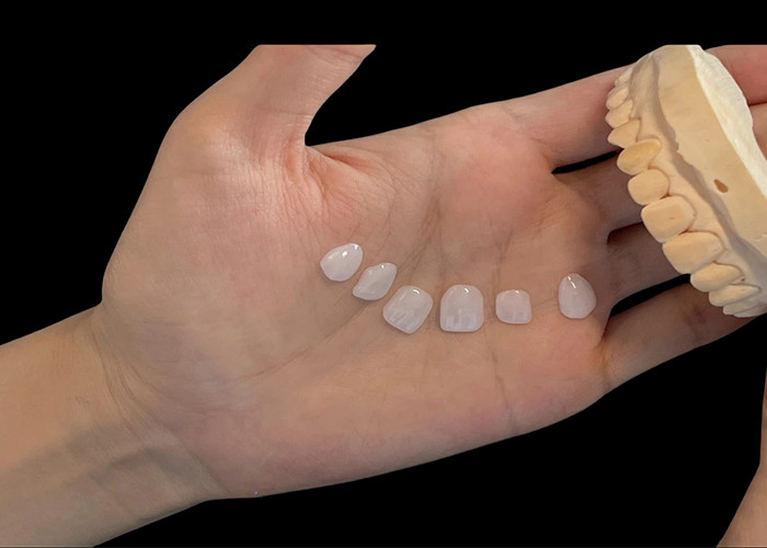 رنگ پورسلین Ultra Thin EMAX Veneers مقاوم به لکه برای بازسازی زیبایی