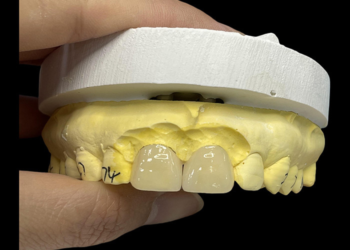 رنگ پورسلین Ultra Thin EMAX Veneers مقاوم به لکه برای بازسازی زیبایی