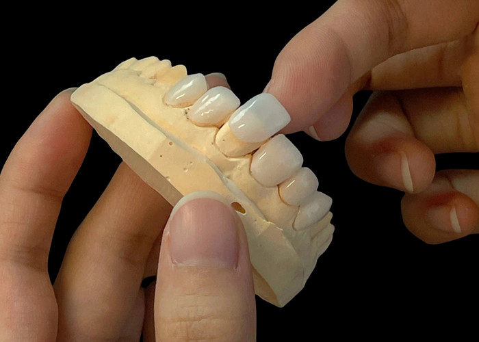 رنگ پورسلین Ultra Thin EMAX Veneers مقاوم به لکه برای بازسازی زیبایی