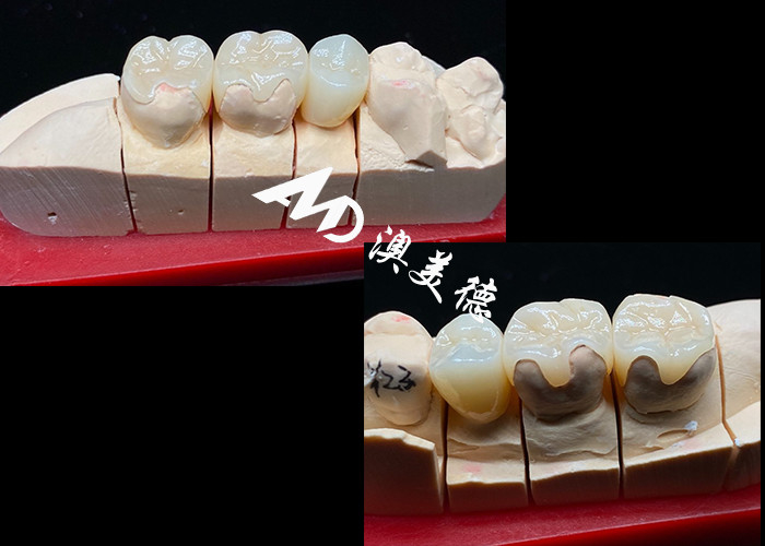 OEM Precision Fit Ceramic Inlays Onlays برای بازسازی دندان های پایدار و طبیعی با قدرت و قابلیت اطمینان برتر
