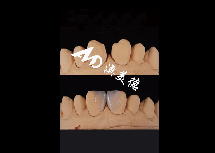 0.3-0.5mm Ultra thin IPS EMAX Porcelain Veneers برای تغییر زیبایی لبخند