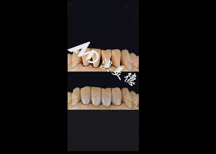 0.3-0.5mm Ultra thin IPS EMAX Porcelain Veneers برای تغییر زیبایی لبخند