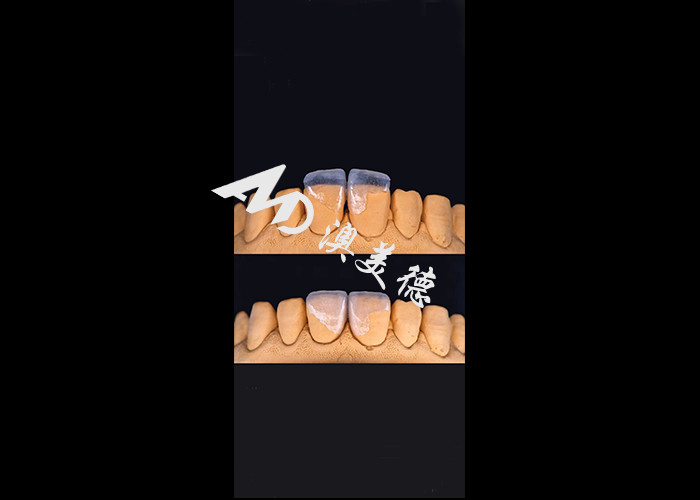 0.3-0.5mm Ultra thin IPS EMAX Porcelain Veneers برای تغییر زیبایی لبخند