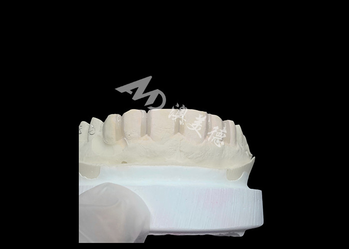 IPS Emax Veneers حداقل آماده سازی / بدون آماده سازی Veneers راه حل های نوآورانه برای لبخند زیبا هستند