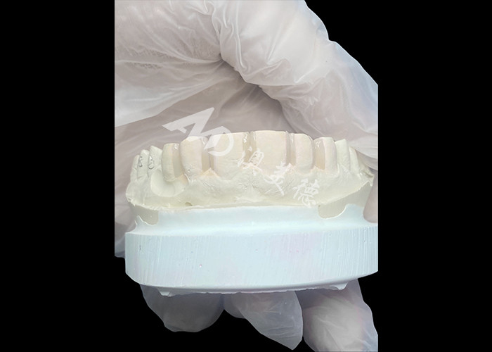 IPS Emax Veneers حداقل آماده سازی / بدون آماده سازی Veneers راه حل های نوآورانه برای لبخند زیبا هستند