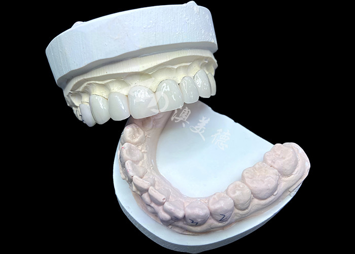 IPS e.max فنیرها در سایه BL2 به زیبایی طبیعی شگفت انگیز با 8 واحد کاملاً ساخته شده دست می یابند