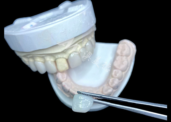 IPS e.max فنیرها در سایه BL2 به زیبایی طبیعی شگفت انگیز با 8 واحد کاملاً ساخته شده دست می یابند