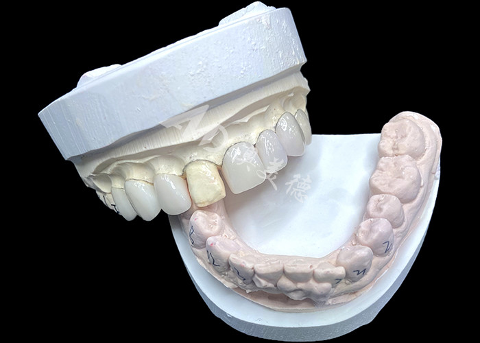IPS e.max فنیرها در سایه BL2 به زیبایی طبیعی شگفت انگیز با 8 واحد کاملاً ساخته شده دست می یابند