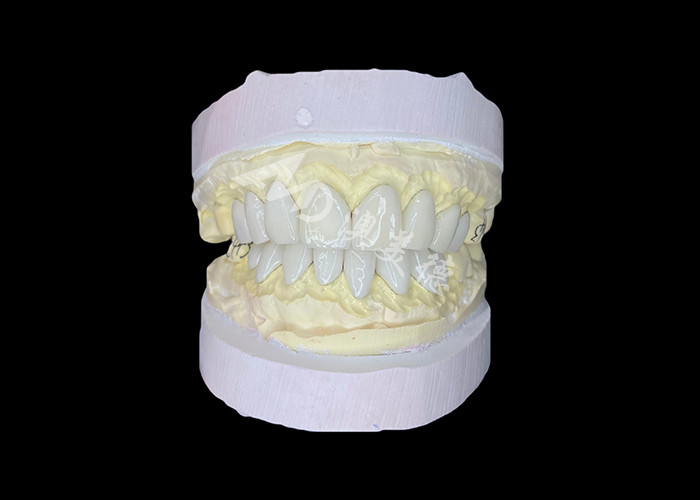 فرنیرهای IPS e.max با دقت برای تحولات لبخند بی نظیر که زیبایی خارق العاده ای را ارائه می دهند