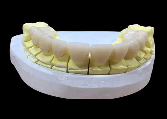 قیمت خوب تاج دندانی پورسلین زرکونیا با زیبایی و ظاهر طبیعی از آزمایشگاه دندان چین آنلاین