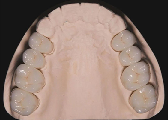 قیمت خوب بازسازی دندان دندان های زیرکونیا تاج های دندان ساخته شده توسط آزمایشگاه دندان چینی آنلاین