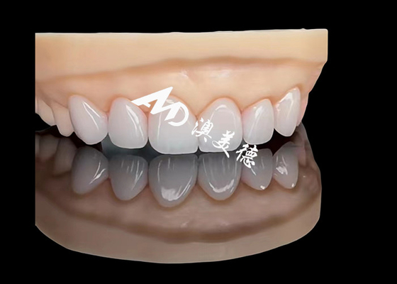 قیمت خوب پورسلین EMAX Veneer بازسازی زیبایی با دقت بالا با دوام برتر آنلاین