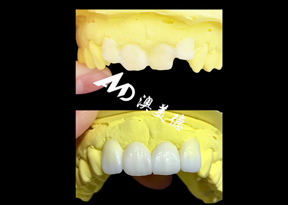 قیمت خوب تاج های دندانی شفاف زرکونیا سفارشی ساخته شده توسط آزمایشگاه دندانی AMD آنلاین