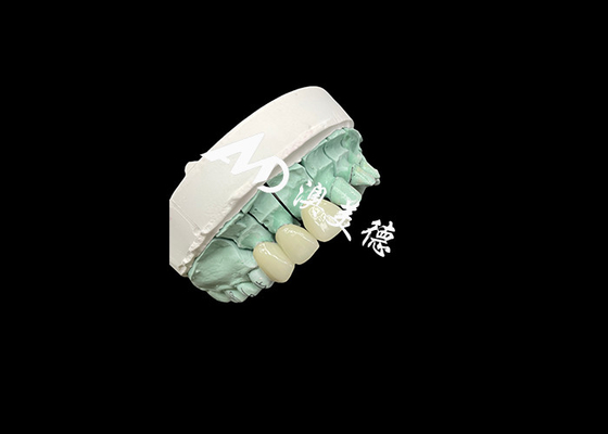 قیمت خوب تاج سرامیکی Emax راه حل قابل تنظیم و مقرون به صرفه برای بازسازی دندان آنلاین