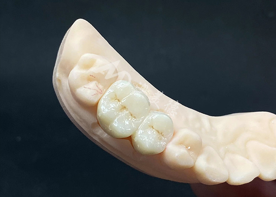 قیمت خوب تاج زیرکونیا شفافیت بالا طراحی طبیعی با مقاومت در برابر شکستگی آنلاین