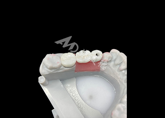 قیمت خوب تاج های ایمپلنت دندان زرکونیا با تیتانیوم برای ارتقاء راحتی و زیبایی آنلاین