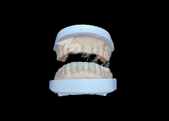 قیمت خوب IPS Emax Veneers بازسازی ظاهر طبیعی برای لبخند زیبایی آنلاین
