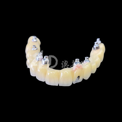 قیمت خوب پل پیچ‌شونده پرسلن-متال (PFM) ایمپلنت آنلاین